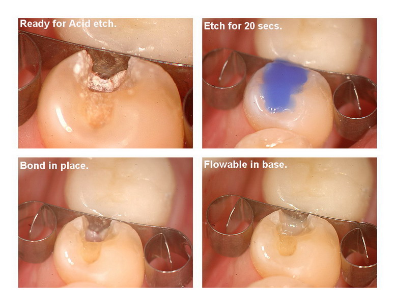 Amalgam removal 5_resize.jpg